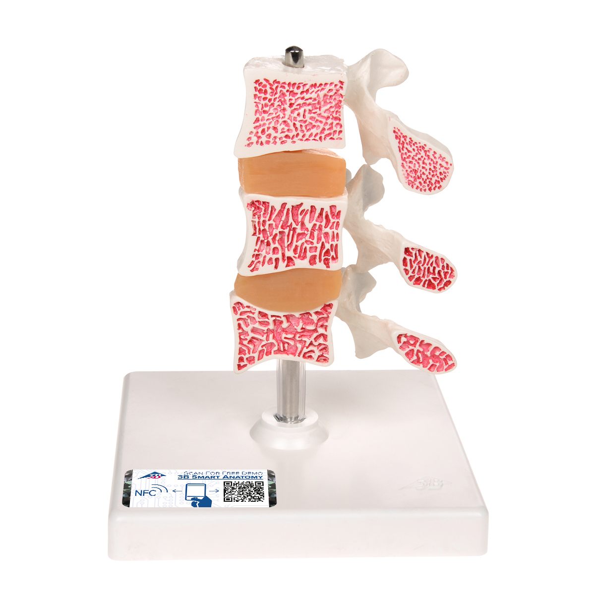 Deluxe Osteoporosemodel